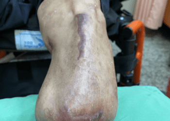 影音/糖尿病患因病變去年左腳截肢　員榮傷口治療今年保住右腳